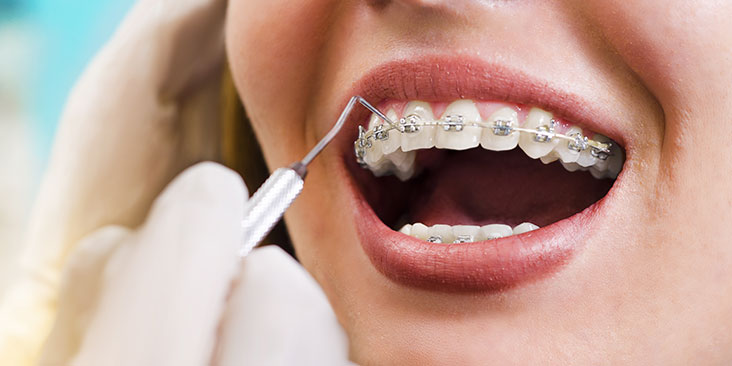 How to take care of your teeth after orthodontic treatment